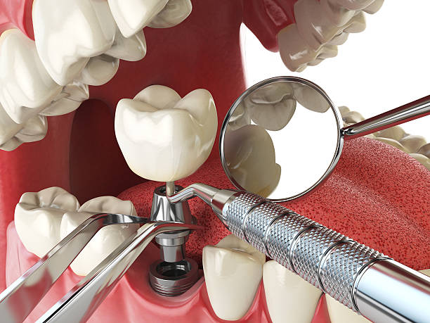 Best Emergency Tooth Extraction in Athena, OR